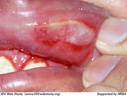 علاج القلاع - مرض جلدي يصيب الفم