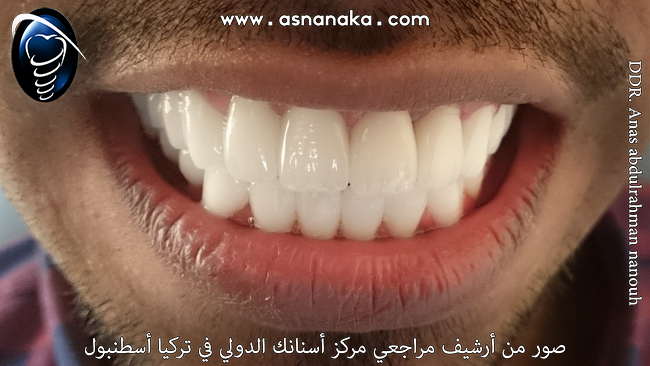 تقويم الأسنان عن طريق تلبيسات الأسنان الزيركونية و إبتسامة هوليود